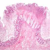 Ziekte van Crohn en colitus ulcerosa thumb e